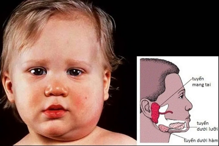 Bệnh quai bị bao lâu thì khỏi?- Ảnh 1.
