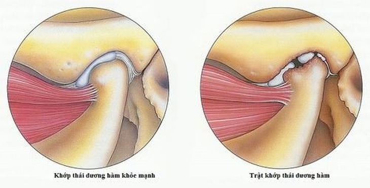 Trật khớp thái dương hàm có biểu hiện gì?- Ảnh 1.