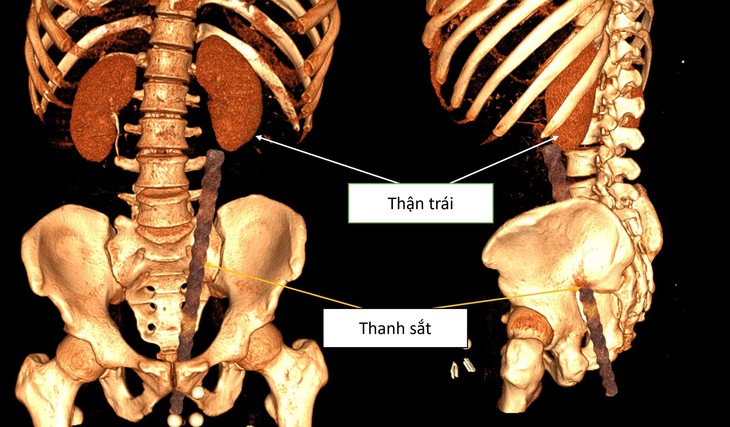 Tai nạn hi hữu: Nam thanh niên bị cọc sắt xuyên qua hậu môn sau cú ngã ngồi- Ảnh 1. Tai nạn hi hữu: Nam thanh niên bị cọc sắt xuyên qua hậu môn sau cú ngã ngồi- Ảnh 1.