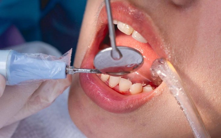 Những ai cần thận trọng khi lấy cao răng? 