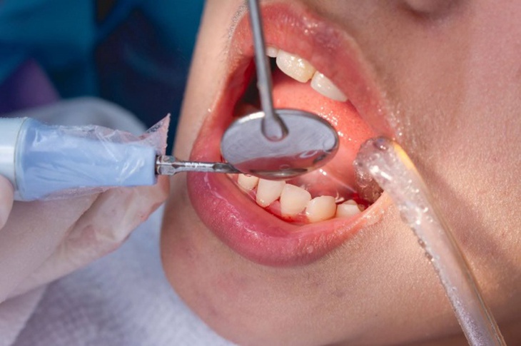 Những ai cần thận trọng khi lấy cao răng? - Ảnh 1.