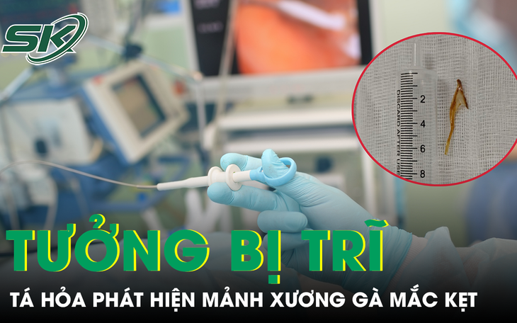 Mảnh xương 2 cm nằm sâu trong phế quản, gây tắc phổi và nhiều ổ mủ
- Ảnh 2.