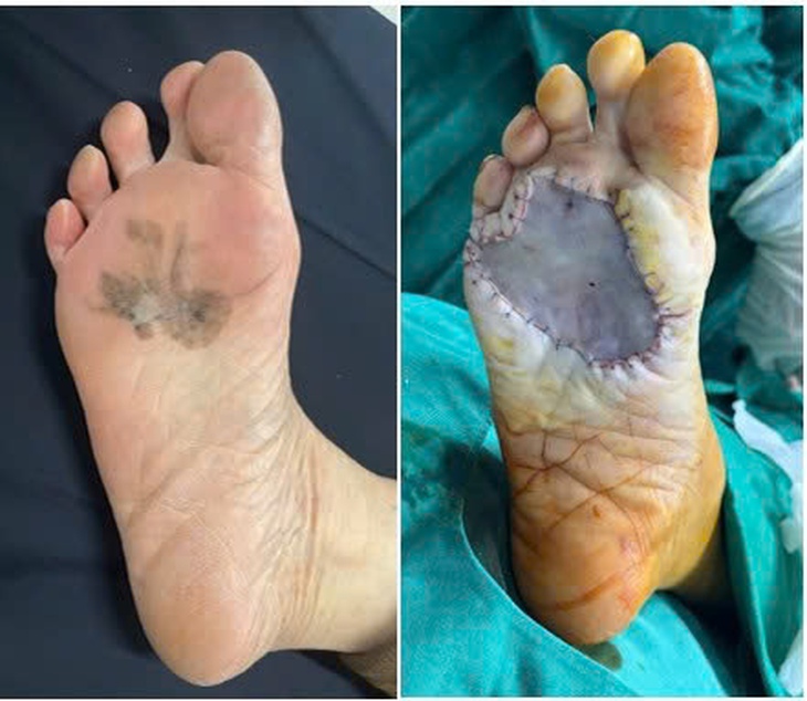 Vết đen ở bàn chân suốt 15 năm mới phát hiện ung thư- Ảnh 1. Vết đen ở bàn chân suốt 15 năm mới phát hiện ung thư- Ảnh 1.