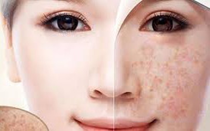 Đốm đồi mồi: Có nên dùng nước cốt chanh để làm mờ? - Ảnh 1.
