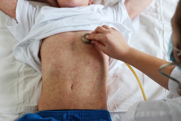 Cách chăm sóc, điều trị và phòng ngừa bệnh sởi | Hapacol