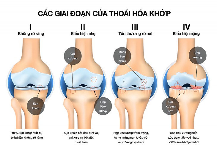 Hội chứng đầu gối ở người chạy bộ: Phòng thoái hóa khớp gối từ những dấu hiệu sớm- Ảnh 1. Hội chứng đầu gối ở người chạy bộ: Phòng thoái hóa khớp gối từ những dấu hiệu sớm- Ảnh 1.