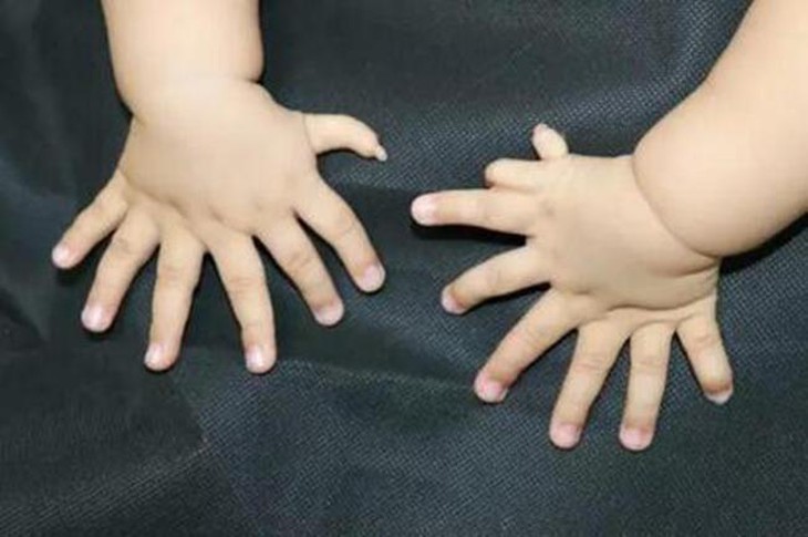 Dị tật thừa ngón tay ở trẻ là một trong những bất thường bẩm sinh khá phổ biến ở tay.