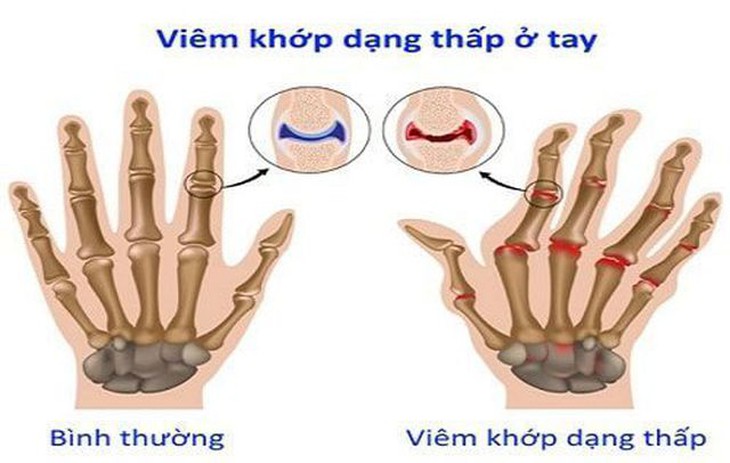 Dùng thuốc điều trị viêm khớp dạng thấp: Những điều người bệnh cần biết- Ảnh 1. Dùng thuốc điều trị viêm khớp dạng thấp: Những điều người bệnh cần biết- Ảnh 1.