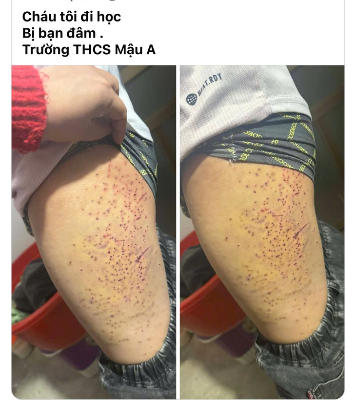 Xác minh thông tin học sinh bị bạn 'đâm' gây thương tích ở Lào Cai- Ảnh 1. Xác minh thông tin học sinh bị bạn 'đâm' gây thương tích ở Lào Cai- Ảnh 1.