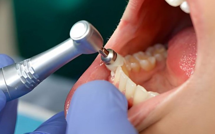 Nên lấy cao răng bao lâu một lần?