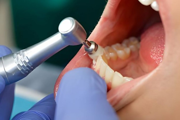 Nên lấy cao răng bao lâu một lần?- Ảnh 2. Nên lấy cao răng bao lâu một lần?- Ảnh 2.