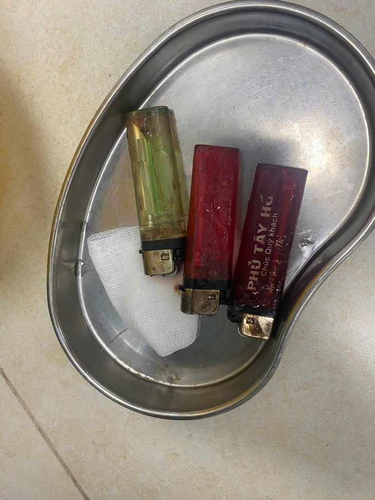 3 chiếc bật lửa trong dạ dày nam thanh niên- Ảnh 3.