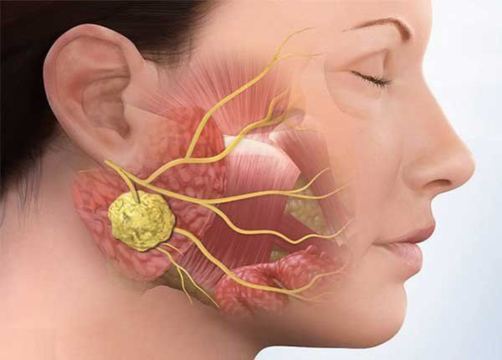 U tuyến mang tai có biểu hiện như thế nào?- Ảnh 1. U tuyến mang tai có biểu hiện như thế nào?- Ảnh 1.