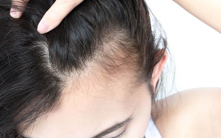 Lời khuyên cho người kích thích mọc tóc bằng vitamin B1- Ảnh 2.
