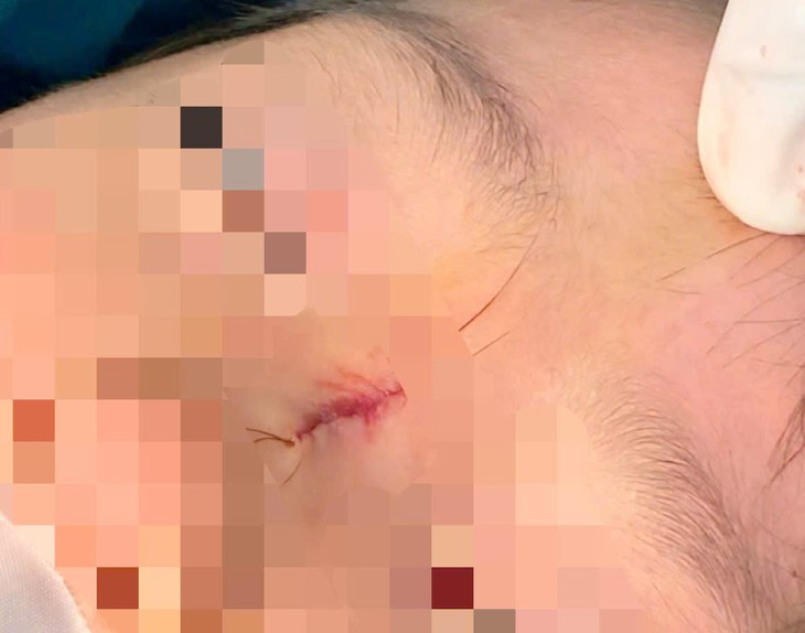 Sưng sống mũi kéo dài ở trẻ, bác sĩ cảnh báo dị tật hiếm gặp- Ảnh 1. Sưng sống mũi kéo dài ở trẻ, bác sĩ cảnh báo dị tật hiếm gặp- Ảnh 1.