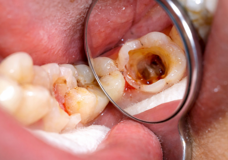 5 biện pháp tự nhiên giảm triệu chứng sâu răng- Ảnh 1.