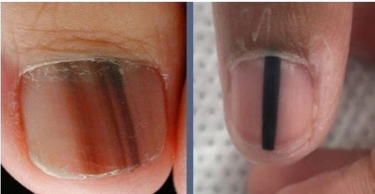 Sọc sẫm màu trên móng tay, móng chân là biểu hiện của bệnh gì?- Ảnh 1.