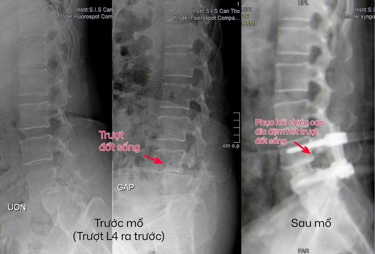 Trượt đốt sống sau té ngã, bệnh nhân được cứu bằng mổ nội soi ít xâm lấn- Ảnh 1.