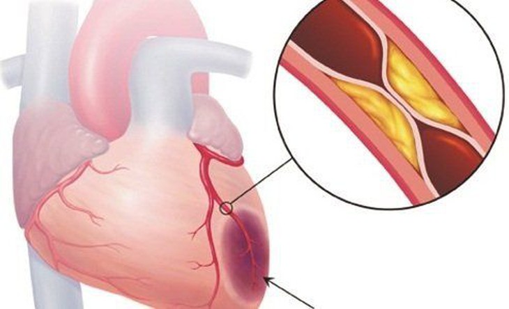 Dùng thuốc đúng cách giúp kiểm soát mỡ máu cao, phòng ngừa biến chứng tim mạch- Ảnh 1.