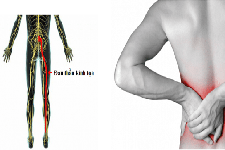 Vitamin và khoáng chất nào tốt cho người đau thần kinh tọa?- Ảnh 1.