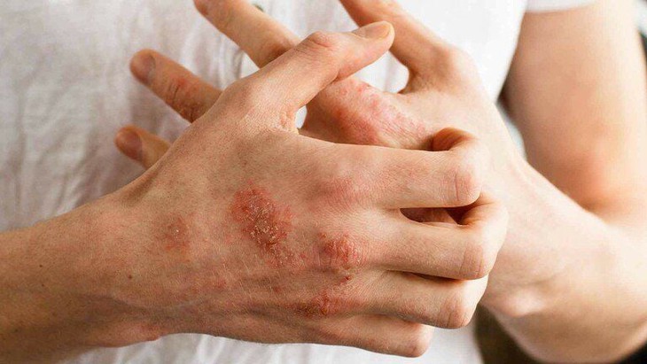 Ảnh hưởng lên da của bệnh đái tháo đường, dấu hiệu không nên bỏ qua- Ảnh 1.