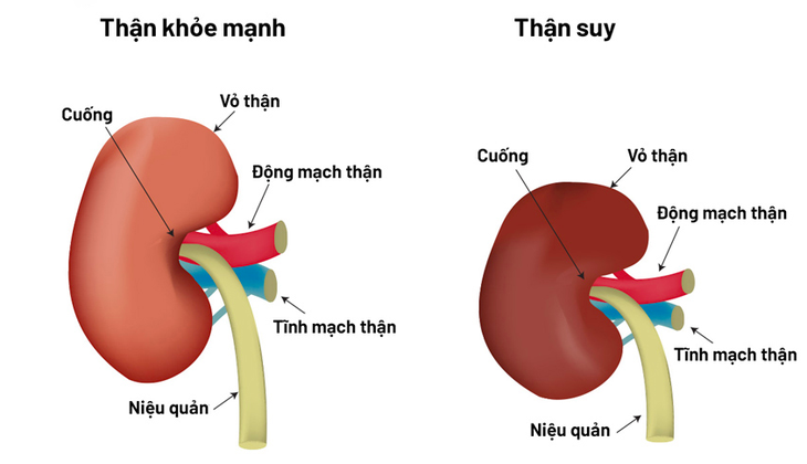 Bác sĩ chỉ 4 dấu hiệu suy thận ở người trẻ dễ bỏ qua- Ảnh 1.