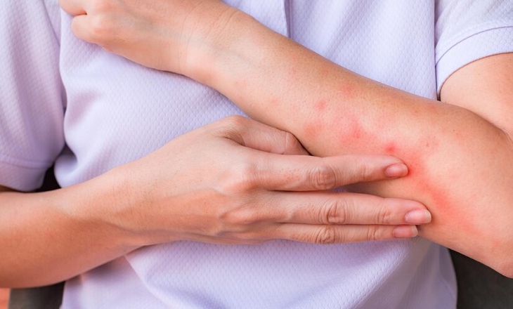 Viêm da dị ứng mùa Xuân: Lưu ý khi tự điều trị, tránh lạm dụng thuốc bôi- Ảnh 1.