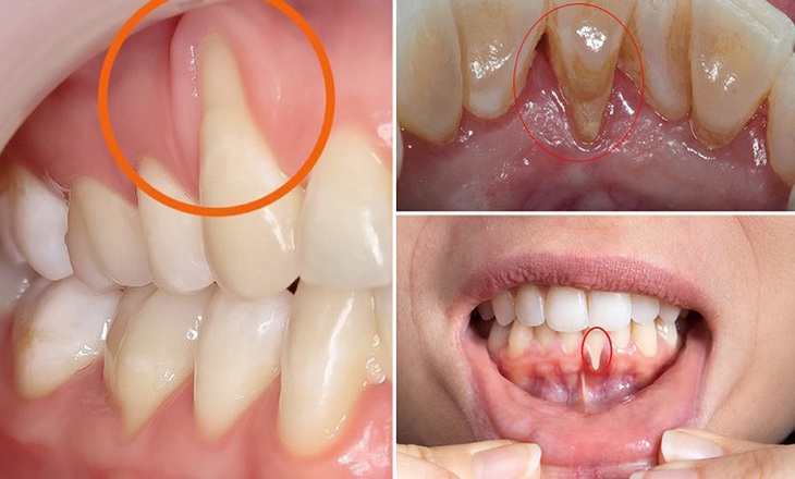 Tụt lợi có thực sự nguy hiểm?- Ảnh 1.
