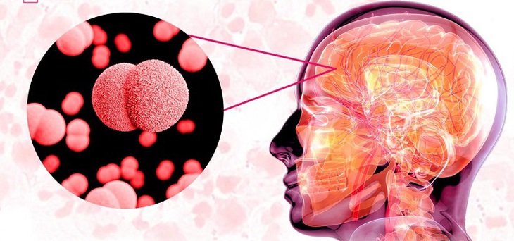 Viêm não mô cầu lây truyền như thế nào và dấu hiệu nhận biết đặc trưng- Ảnh 1.