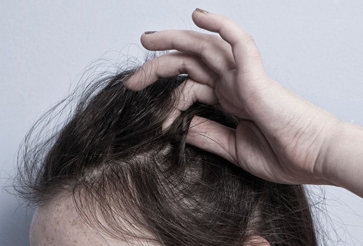 Hội chứng nghiện giật tóc (trichotillomania) là một rối loạn tâm lý khiến người bệnh có xu hướng nhổ tóc một cách lặp đi lặp lại, khó kiểm soát.