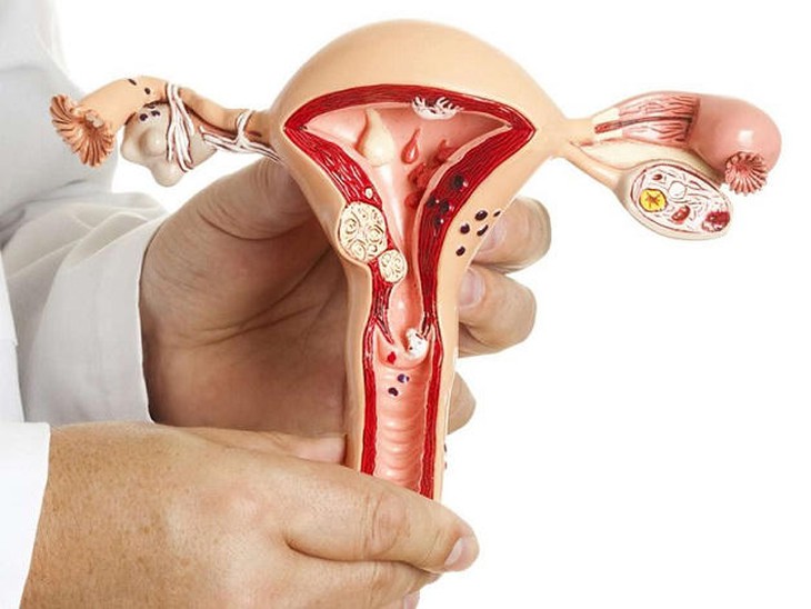 Vì sao nhân xơ tử cung khiến phụ nữ khó có thai?- Ảnh 1.