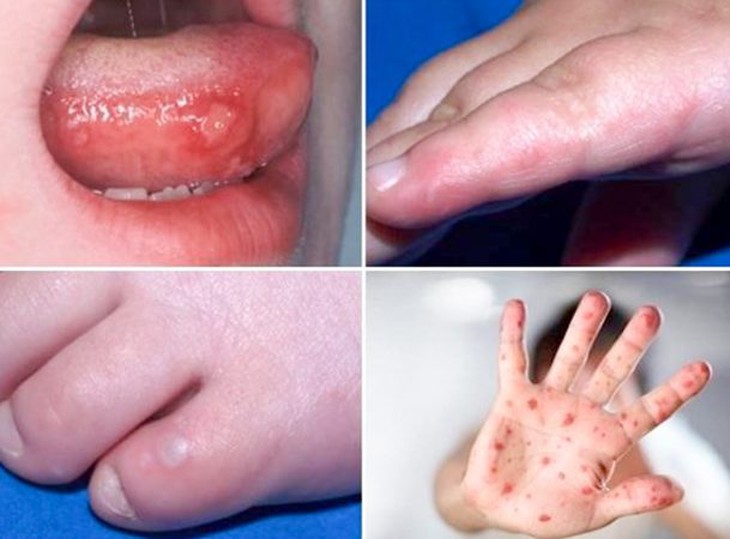 Trẻ mắc tay chân miệng chỉ sốt, loét miệng, không có nhiều mụn nước vẫn có nguy cơ diễn biến nặng nhanh chóng- Ảnh 1.