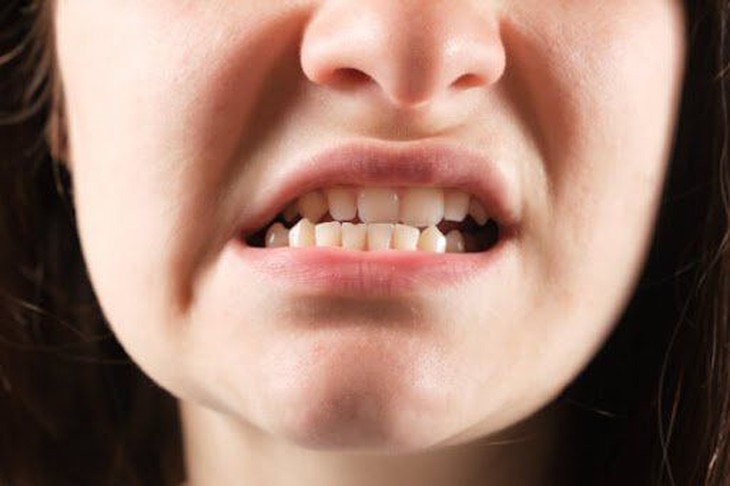 Lệch khớp cắn có gây bệnh lý răng miệng?- Ảnh 1. Lệch khớp cắn có gây bệnh lý răng miệng?- Ảnh 1.