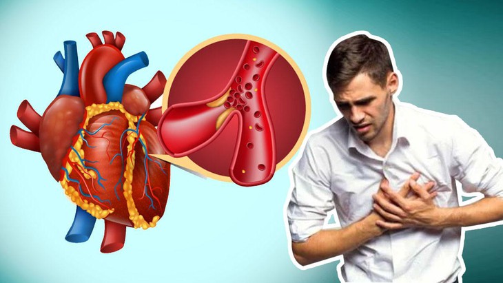Bệnh tim mạch là gì? Vì sao bệnh tim mạch ngày càng trẻ hóa? - Bệnh Viện FV