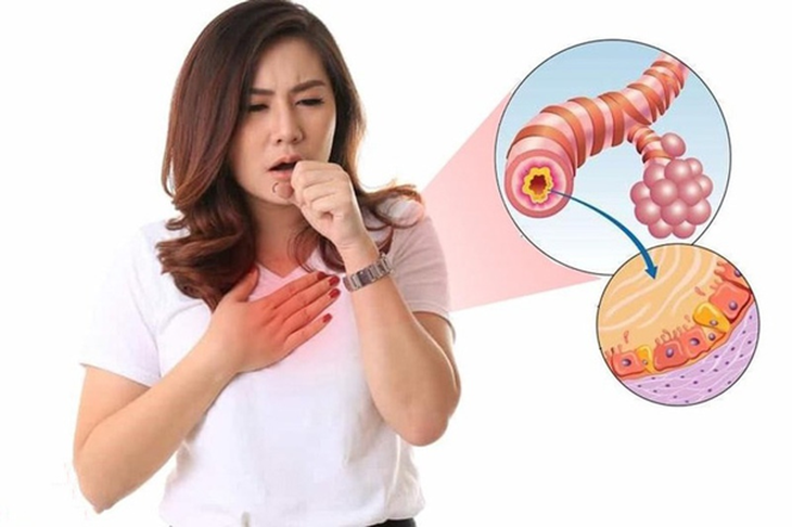 Dùng kháng sinh điều trị viêm phế quản cấp tính: Hiểu đúng để điều trị hiệu quả- Ảnh 1.