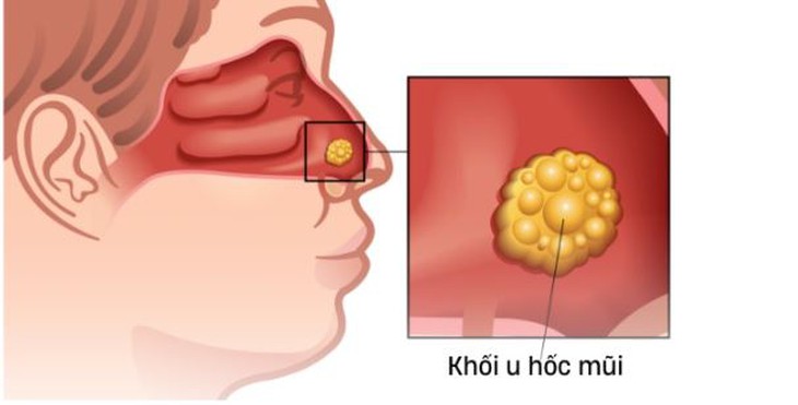 Nghẹt mũi kéo dài cảnh giác với ung thư hốc mũi- Ảnh 1.