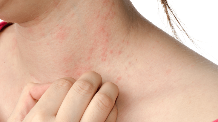 Xử trí đúng cách bệnh da do côn trùng
- Ảnh 1.