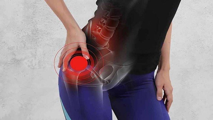 Viêm khớp háng, nhận biết sớm giúp ngăn ngừa hệ lụy- Ảnh 1.