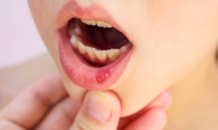 Ứng phó với 'nóng trong', nổi mụn, nhiệt miệng mùa xuân - Ảnh 1. Ứng phó với 'nóng trong', nổi mụn, nhiệt miệng mùa xuân - Ảnh 1.