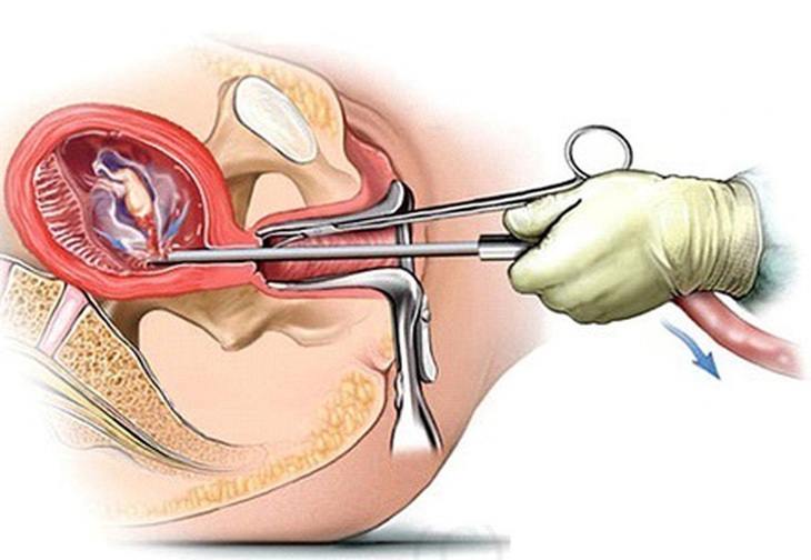 Lâm Đồng: Sẽ đình chỉ, truy cứu hình sự nếu nạo phá thai trái phép gây hậu quả nghiêm trọng- Ảnh 1.