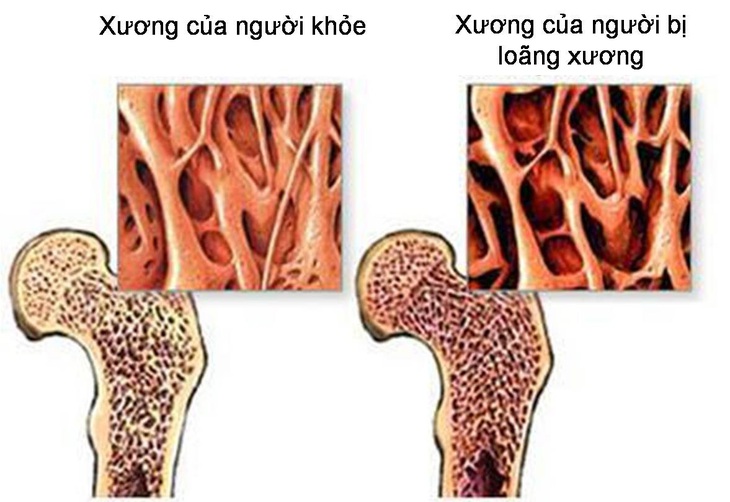 5 cách phòng loãng xương không dùng thuốc trước tuổi 40- Ảnh 1.
