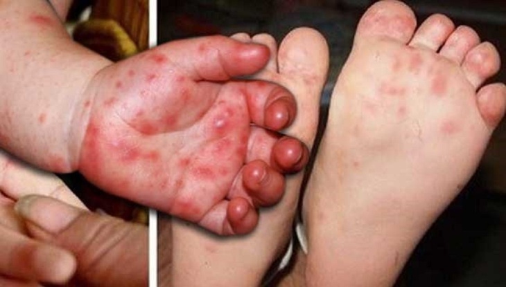 Tay chân miệng ở Khánh Hòa tăng gấp 4 lần năm ngoái, bác sĩ khuyến cáo điều phụ huynh cần làm ngay- Ảnh 1.
