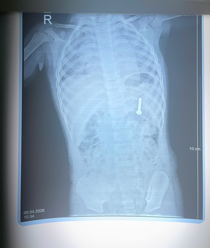 Bé 21 tháng tuổi nuốt phải đinh vít dài khoảng 2,5cm- Ảnh 1.