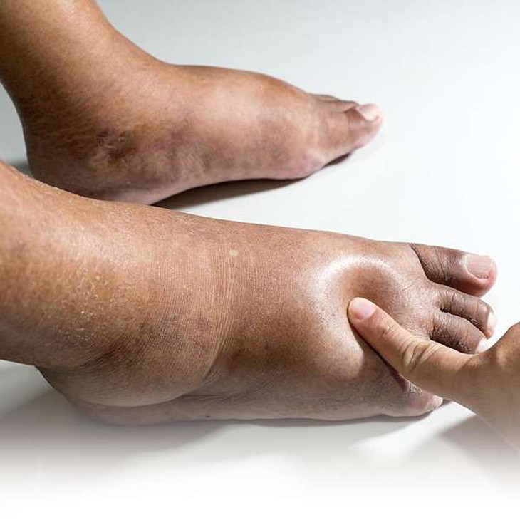 Chân voi là bệnh gì, có nguy hiểm không?- Ảnh 1. Chân voi là bệnh gì, có nguy hiểm không?- Ảnh 1.