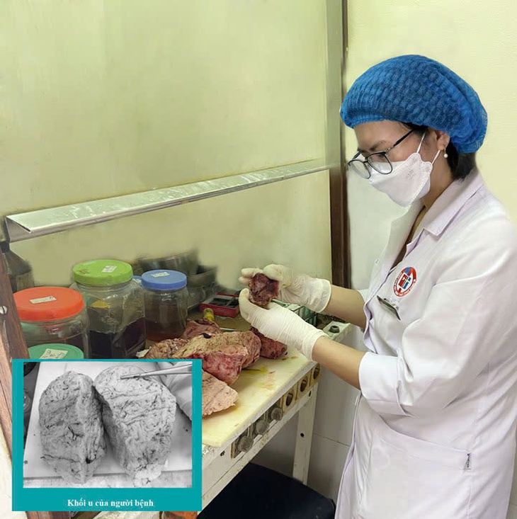Người phụ nữ 46 tuổi mang trong mình khối u tử cung khổng lồ nặng 5kg- Ảnh 1. Người phụ nữ 46 tuổi mang trong mình khối u tử cung khổng lồ nặng 5kg- Ảnh 1.