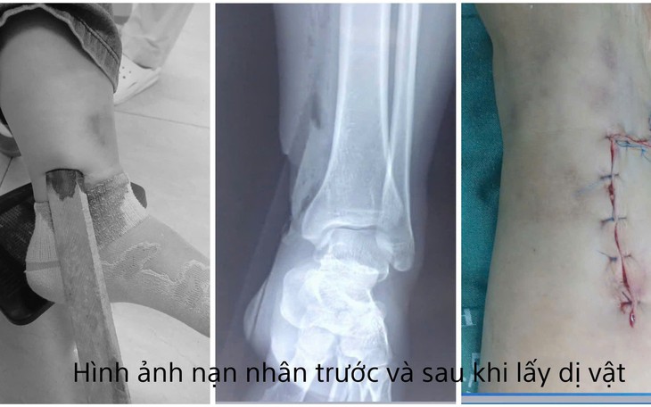 Cụ bà cao tuổi thủng trực tràng vì nuốt hạt nhót- Ảnh 3.