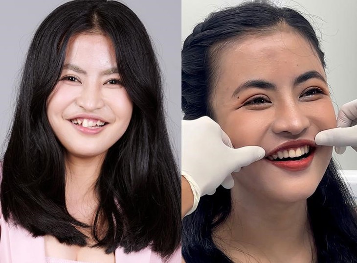 300 giờ phẫu thuật, 120 ngày thay đổi diện mạo: Vì sao chỉnh hàm chưa phải 'điểm kết'?- Ảnh 3. 300 giờ phẫu thuật, 120 ngày thay đổi diện mạo: Vì sao chỉnh hàm chưa phải 'điểm kết'?- Ảnh 3.