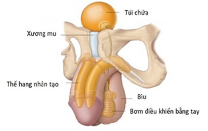 Điều trị rối loạn cương dương bằng lắp 'công tắc' nhân tạo- Ảnh 1. Điều trị rối loạn cương dương bằng lắp 'công tắc' nhân tạo- Ảnh 1.