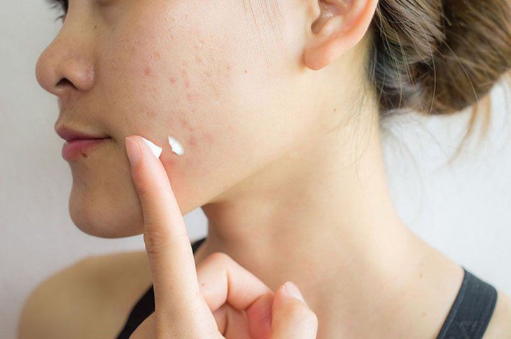 6 sai lầm khi chữa mụn trứng cá- Ảnh 1.