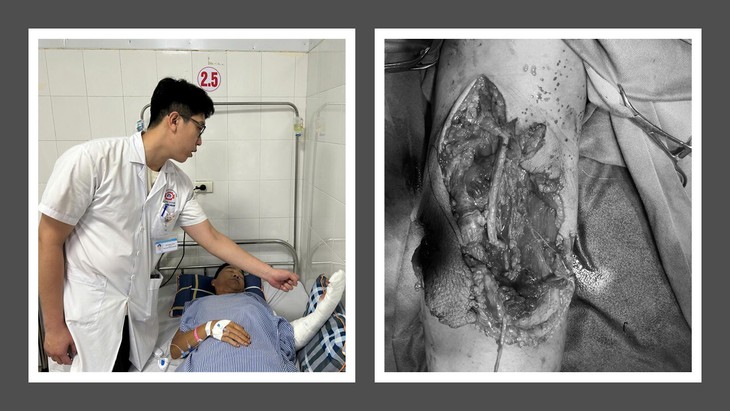 Phối hợp liên viện, cứu sống bệnh nhân đứt động mạch cánh tay- Ảnh 2.